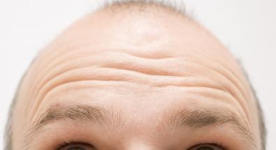 Alopecia: una cura contro lo stress potrebbe combatterla