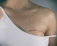 Chirurgia plastica al seno dopo un tumore: quando è possibile?