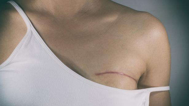 Chirurgia plastica al seno dopo un tumore: quando è possibile?