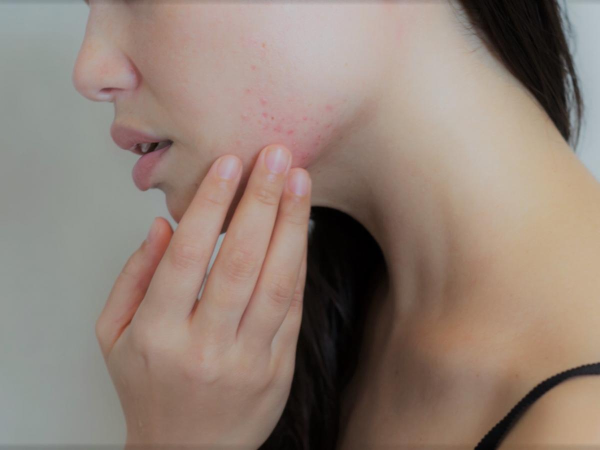 Maskne: come curare l'acne da mascherina Paginemediche