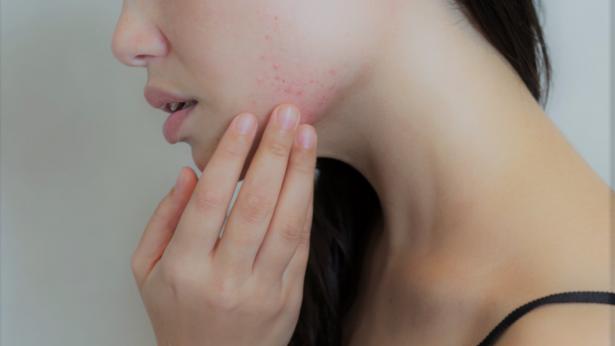 Maskne: come curare l'acne da mascherina