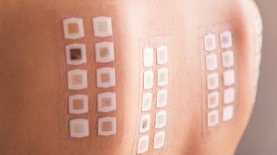 patch test come si esegue