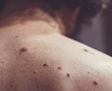 Rischio melanoma più alto negli uomini