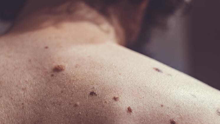 Rischio melanoma più alto negli uomini