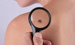 Prevenzione del melanoma: quali controlli fare?