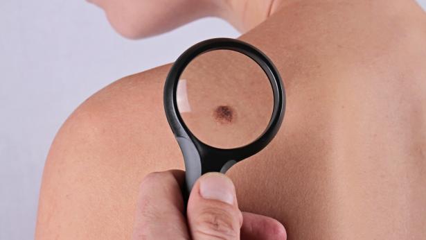 Prevenzione del melanoma: quali controlli fare?