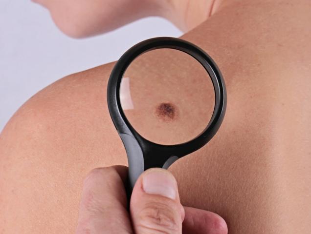 Prevenzione del melanoma: quali controlli fare?