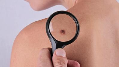 prevenzione del melanoma quali controlli fare