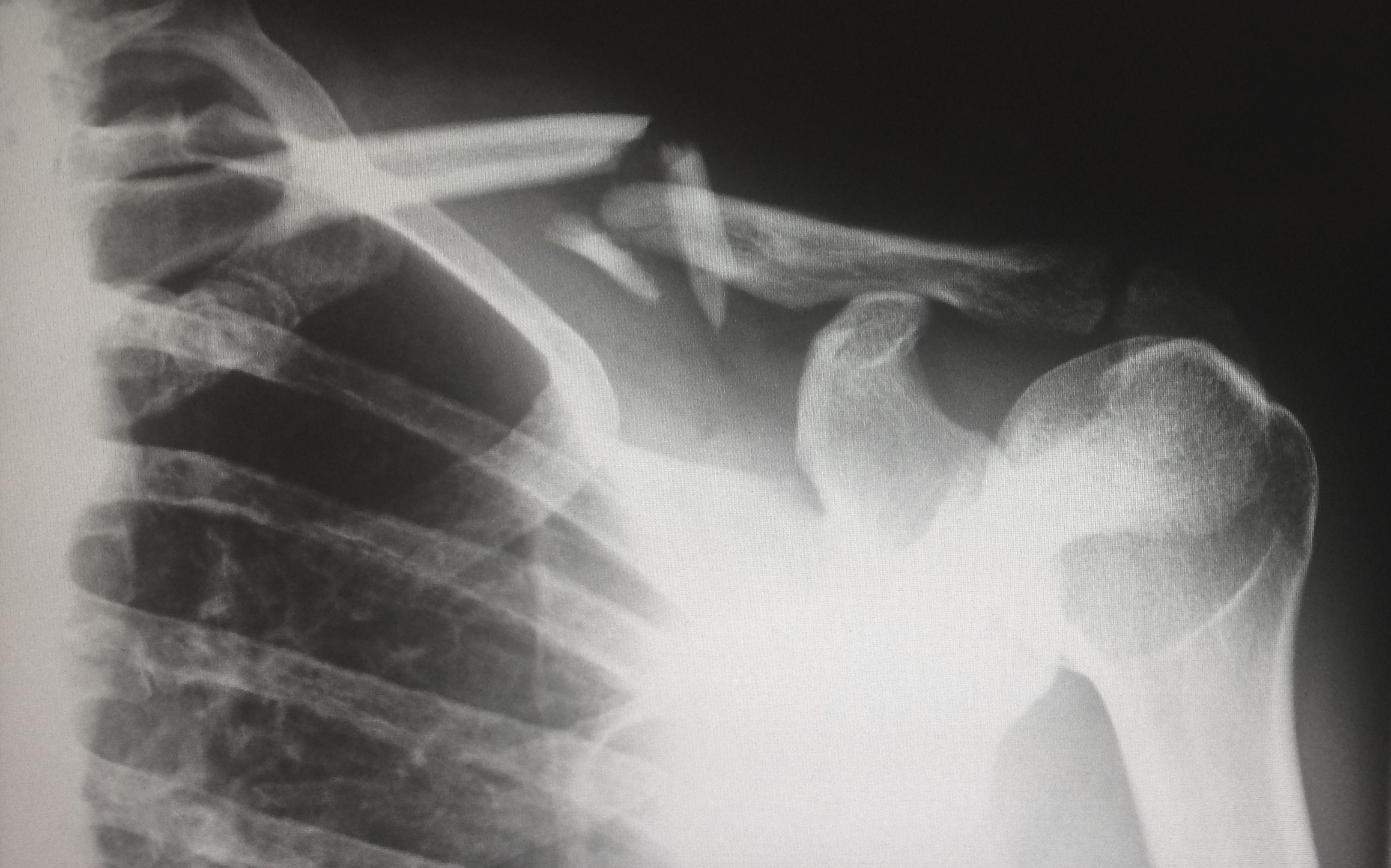 carcinoma prostatico metastasi osseo terapia la