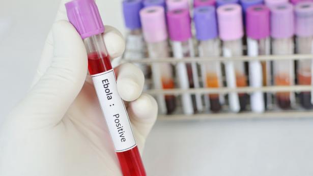 Come si contrae e quali sono i sintomi del Virus Ebola Come si contrae e quali sono i sintomi del Virus Ebola