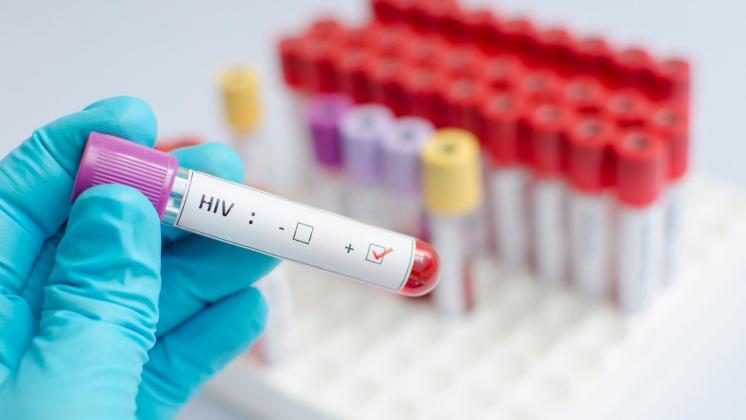 Test da fare per la diagnosi di HIV