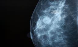 Incidenza del cancro della mammella