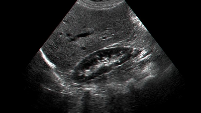ci puo essere correlazione tra calcoli renli e prostata