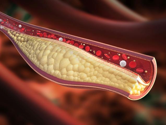 Colesterolo e trigliceridi, qual &egrave; la differenza?