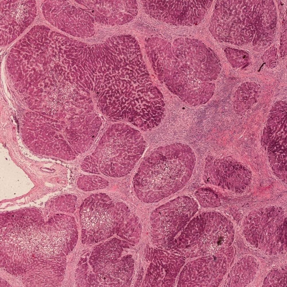 Complicanze Della Cirrosi Epatica Quali Sono Paginemediche