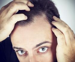Definizione e classificazione delle alopecie