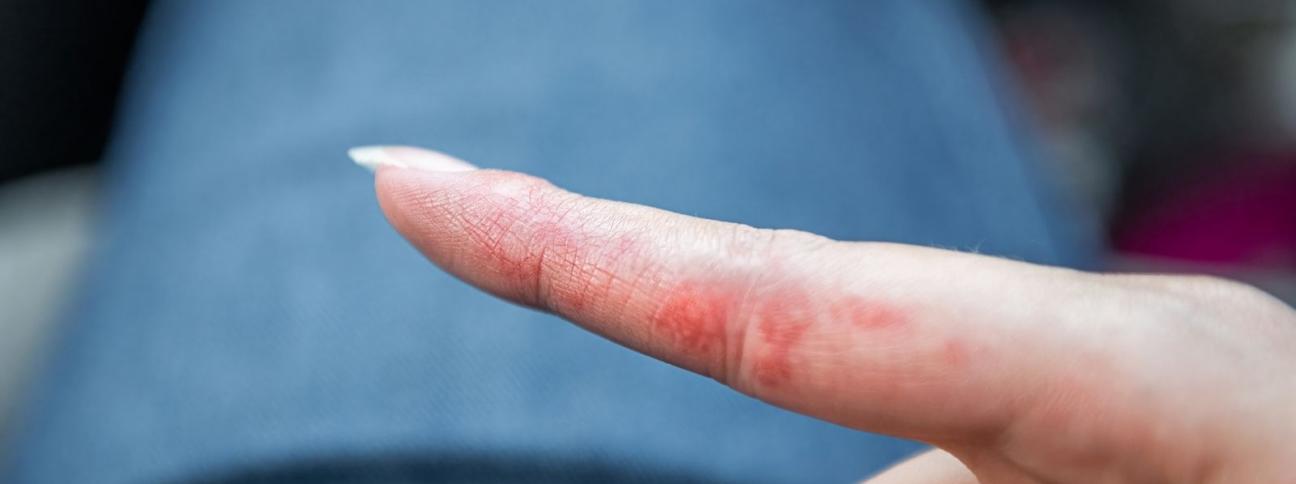 Dermatite da contatto: cause e sintomi