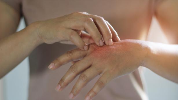 Dermatite da stress: cause, sintomi e rimedi