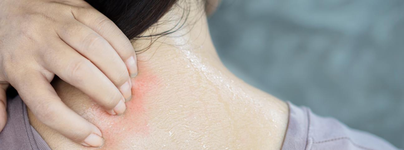 Dermatite da sudore: che cos'è e come si cura