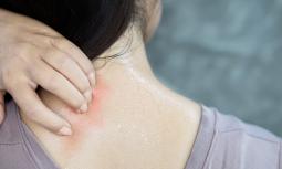 Dermatite da sudore: che cos'è e come si cura
