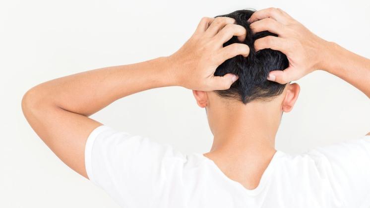 Dermatite seborroica: cause e sintomi