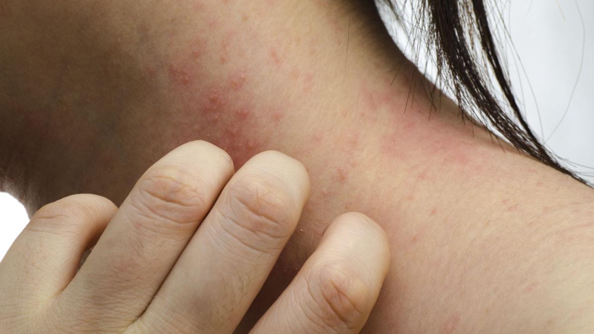 Eczema Cause Sintomi Trattamento Paginemediche