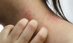 Eczema: cause e sintomi