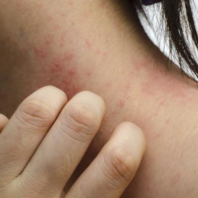 eczema non pruriginoso