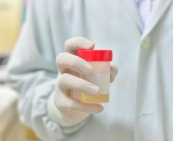 Ematuria: le cause del sangue nelle urine