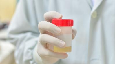 Ematuria: le cause del sangue nelle urine