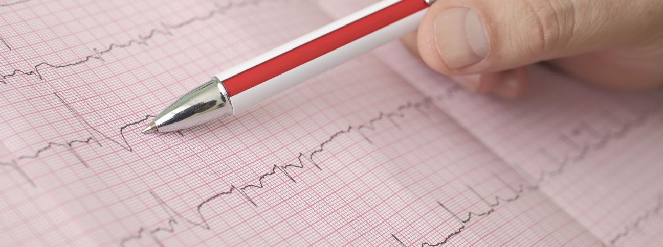 Fibrillazione atriale: cause, sintomi e terapie