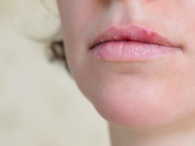 Herpes Simplex Sintomi E Trattamento Paginemediche