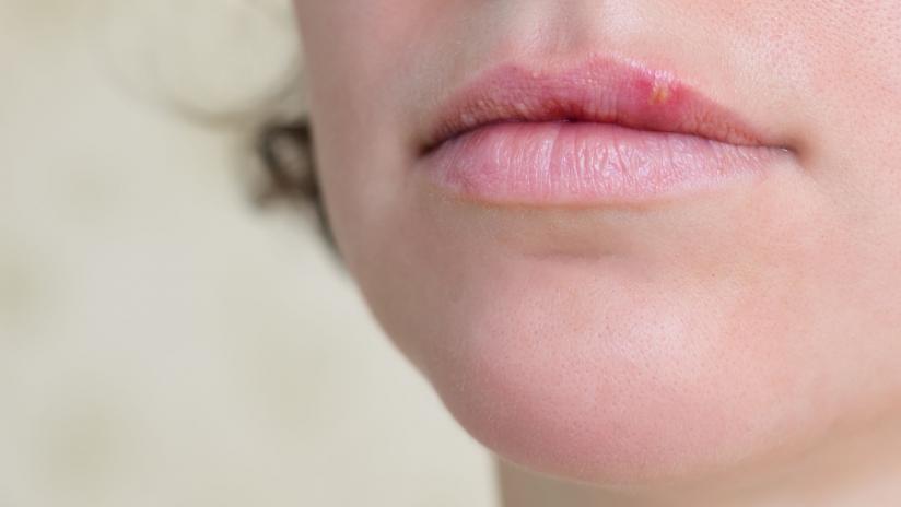 Risultati immagini per herpes simplex