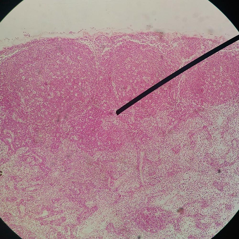 papilloma virus isterectomia)