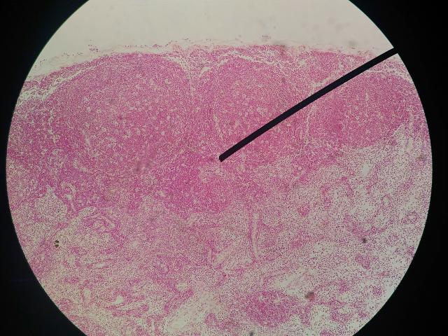 Il papilloma virus guarisce da solo. Papilloma seno b2