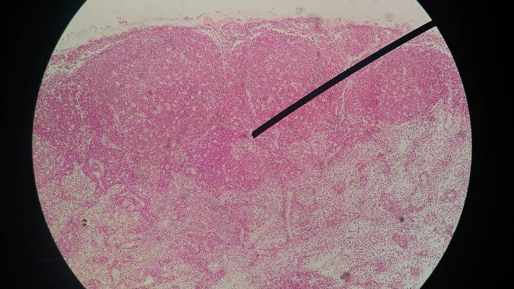 Infezione da papilloma Virus e prevenzione