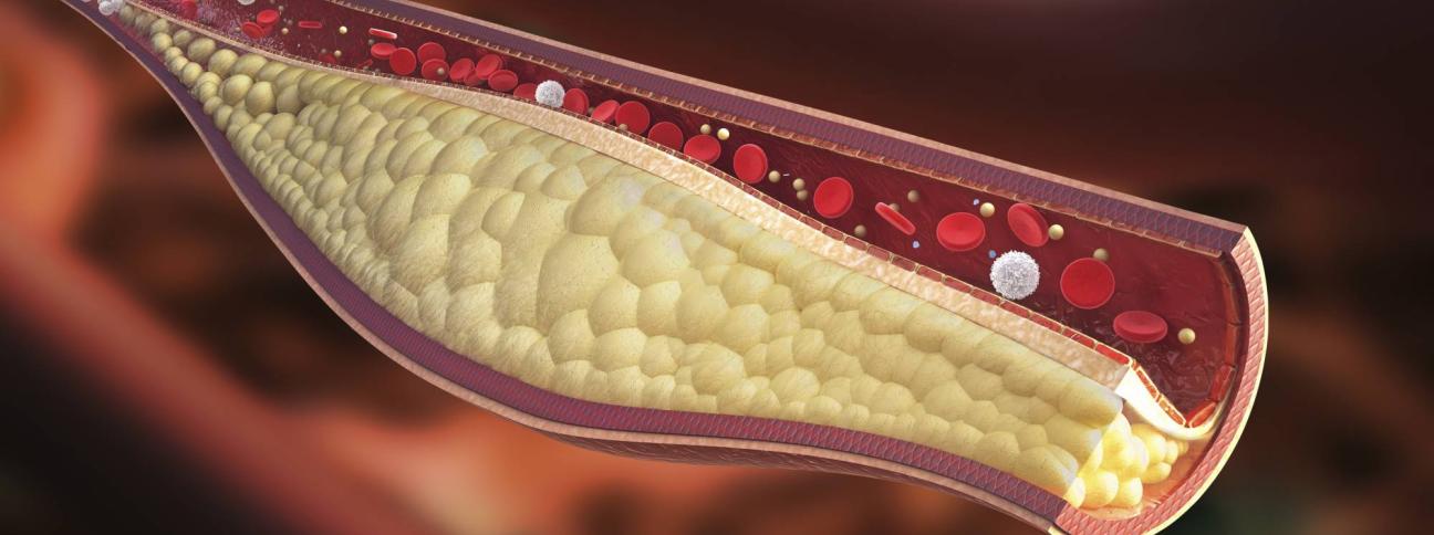Macroangiopatia: una complicanza del diabete
