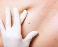 Melanoma: cause e sintomi