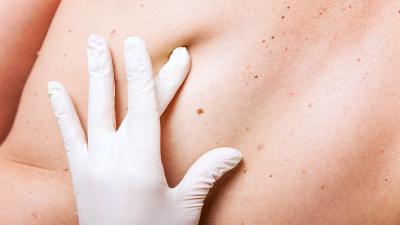 Melanoma: cause e sintomi