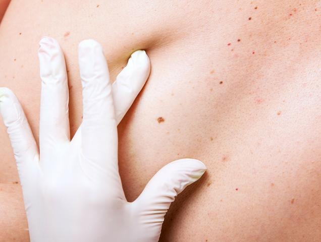 Melanoma: cause e sintomi