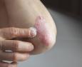 Psoriasi: che cos'è e che cosa fare