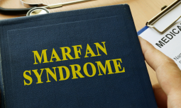 Sindrome di Marfan: cosa sapere