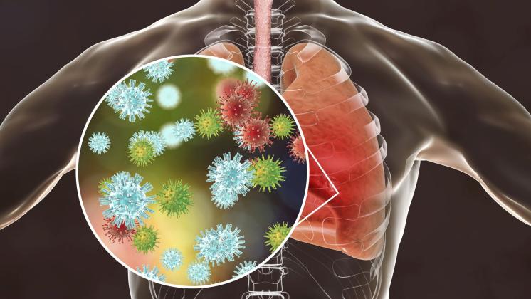 Sindrome Respiratoria Acuta Severa: SARS