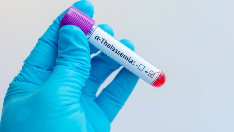 Talassemia o anemia mediterranea: che cos'è?