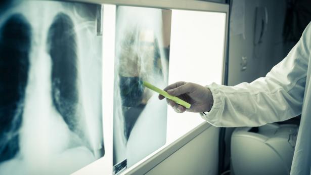 Tumore ai polmoni: sintomi, diagnosi e prevenzione