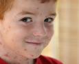 Varicella: sintomi e rischi per adulti e bambini