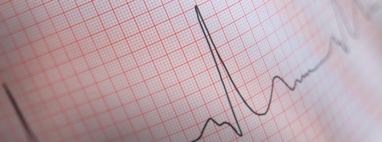 Elettrocardiogramma (ECG): che cos'è e quando si esegue