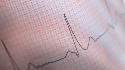 Elettrocardiogramma (ECG): che cos'è e quando si esegue