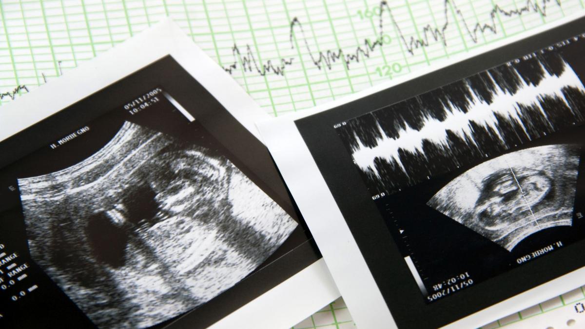 Aborto e battito fetale, la prassi (non richiesta) della doppia ecografia  per avere il via libera all'interruzione: come funziona in Italia - Il  Fatto Quotidiano