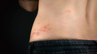 L’ossigeno ozonoterapia nell’herpes zoster ed altre malattie virali